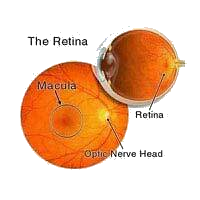 Cataract Image