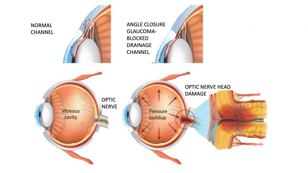 Patient consultation flow while visiting retina clinic at AEH